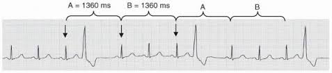 Pvc interpolated by the eccles health sciences library is licensed under the creative. Premature Supraventricular Complexes Basic And Bedside Electrocardiography 1st Edition 2009