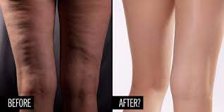 Collagen hydrolysate, hydrolyzed collagen, or collagen peptides. People Are Saying This Secret Supplement Smooths Cellulite
