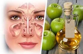 Hausmittel Gegen Verstopfte Nasennebenhohlen Besser Gesund Leben Nasennebenhohlen Besser Gesund Leben Gesundheit