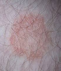 O primeiro é a cirurgia extensa feita para retirar as partes afetadas pelo fungo, seja a pele ou até. Dermatofitose Wikipedia A Enciclopedia Livre