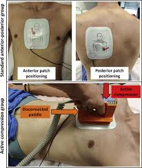 Manual internal defibrillators deliver the shock through paddles placed directly on the heart.1 they are mostly used in the. Active Compression Versus Standard Anterior Posterior Defibrillation For External Cardioversion Of Atrial Fibrillation A Prospective Randomized Study Sciencedirect