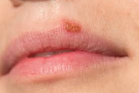 Image result for Oral herpes roof of mouth