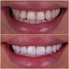 Los angeles and the nfl could write a bad romance. Before After Smile Gallery Los Angeles Cosmetic Dentist