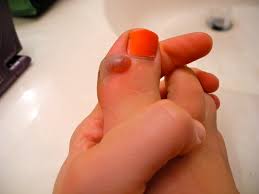 Check spelling or type a new query. Blood Blister Surgery Run Inspired