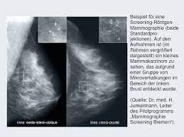 2 wichtige argumente für die mammographie. Bfs Rontgen Das Mammographie Screening Programm In Deutschland
