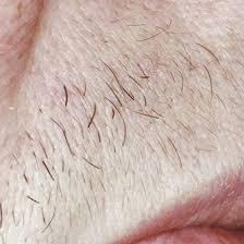Laser hair removal is the most frequent cosmetic use of lasers for the skin. Laser Hair Removal Treatment Cynosure