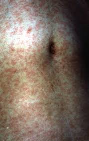 Image result for measles