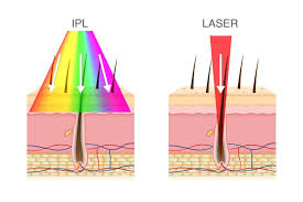 Die moderne laser haarentfernung für zuhause. Ipl Oder Laser Vor Und Nachteile Im Uberblick Haarentfernung Ipl