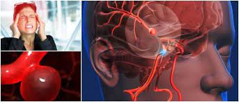 O aneurisma cerebral é uma dilatação anormal provida de uma das artérias da região cerebral. Aneurisma Cerebral Definicion Causas Factores De Riesgo Sintomas Diagnostico Y Tratamiento Arriba Salud