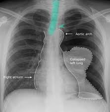 It may occur spontaneously without a known cause, often in healthy people. Pneumothorax Amboss