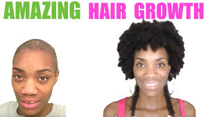 African american hair comes in a variety of textures, and different types of hair have different needs. Black Woman Alopecia All You Need To Know About The Hair Disease