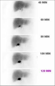 Image result for HIDA Scan