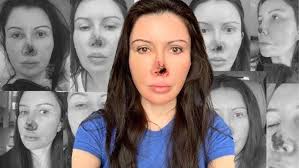 My Face Lift Before and After: Part 2