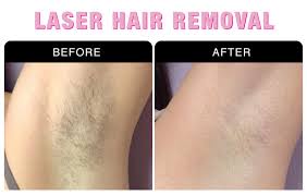 The laser equipments used at radiant are imported from the usa and israel and are us fda approved and with unique inbuilt cooling technology. Laser Hair Removal Services At National Laser Institute