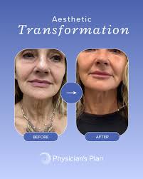 You don't have to “just live with it.” Bianca came to our Hickory team  wanting a smoother, more youthful look, especially in the neck area. With a  custom treatment plan from Britney (