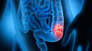 Maybe you would like to learn more about one of these? E Coli Gut Infection Linked To Bowel Cancer Bbc News
