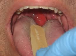 Image result for Uvulitis