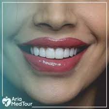 Veneers cost between $250 and $2,500 per tooth, according to authority dental, which provides dental information that has been reviewed by dentists or dental technicians. Dental Veneers In Iran Affordable Porcelain Veneers Ariamedtour