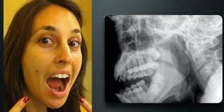 Image result for Jaw Dislocation