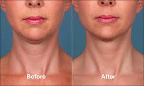 The number of treatments you'll need will play a vital role in the total cost. St Louis Kybella Double Chin Treatment St Louis Lipo Center