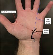 Image result for Hamate Bone