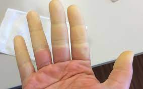 Raynaud Syndrom Ursachen Symptome Therapie Onmeda De