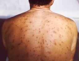 Image result for Varicella zoster on human skin