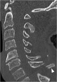 This may be done through diet and exercise. Isolated Spinous Process Fractures Case 24 Clinical Imaging Of Spinal Trauma