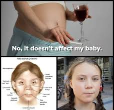 Increased breadth of nasal bridge; No It Doesn T Affect My Baby Fetal Alcohol Syndrome Microcephaly Small Palpebral Fissures Railroad Track