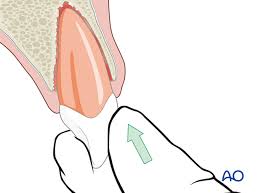Image result for Tooth Avulsion