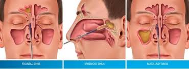 Nasal polyps may form anywhere in your sinuses or nasal passages, but they appear most often in an area where sinuses near your eyes, nose, and cheekbones. Aarav Medicare