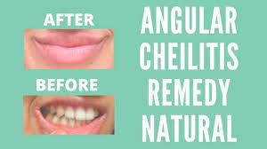 Angular Cheilitis Remedy Natural Dry Lips Remedy Lip Healing Remedies