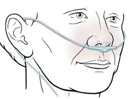 On nasal niv/ram cannula, weight gain was documented and avoided tracheostomy placement. Patient Login Bill Pay Mychart Myfairview Rx Oncare Fairview Find A Doctor Locations Services Specialties Solutions Services Specialties Family Medicine Obstetrics Gynecology Urgent Care Pharmacy Pediatrics Orthopedics Sports Medicine