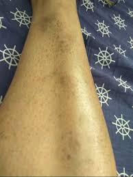 Image result for liver spots on legs