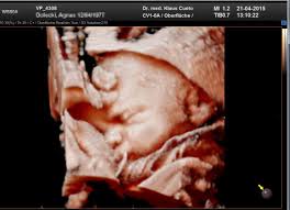 In dieser woche kann man eine schwangerschaft im ultraschall noch nicht sehen, da seit der einnistung gerade. Bilder Cueto Frauenaerzte Koln