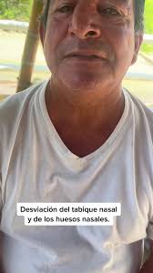En la playa nos encontramos a aun paciente que refiere multiples golpes en  su nariz, lo cual le provocó una desviacion severa del tabique nasal y de  los huesos nasales. #manabi #viral #foryou #parati ...