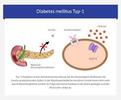 Welche Ursachen Hat Diabetes Euroclinix Informiert