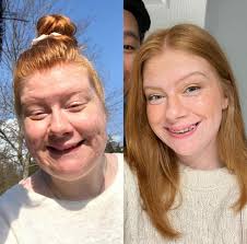 Weight loss transformation story