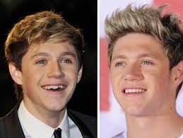 Niall Horan Before And After Dental Work Kid Grew Up In The Spotlight But Became A Positive Role Model For Kids In 2020 Celebrity Teeth Celebrities With Braces Dental