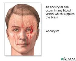 Cerebral Aneurysm Medlineplus Medical Encyclopedia Image Brain Aneurysm Brain Aneurysm Awareness Cerebral Aneurysm