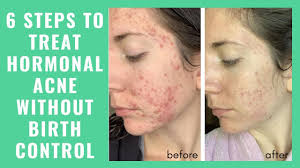 Aloe vera one of the best remedies that help to eliminate hormonal acne naturally is the use of aloe vera or aloe. Cystic Acne Archives Heal Your Face With Food