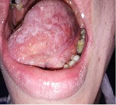 Image result for lichen planus on tongue)