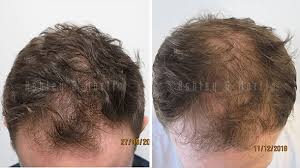 Rassman is a world leading expert in hair loss with over 25 years of experience and over 50,000 satisfied clients. Why Low Dose Oral Minoxidil Treatments For Baldness Should Be Avoided Ashley And Martin