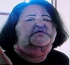 She was only 28 years old when Hang Mioku, a model from South Korea, began  getting silicone injections in her face. She wanted smooth and firm skin,  and believed the injections would