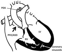 When affected babies cry or have a bowel movement. Pulmonary Atresia With Intact Ventricular Septum Thoracic Key