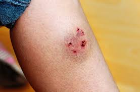 Maybe you would like to learn more about one of these? If A Dog Bites You Do These 6 Things Now Health Essentials From Cleveland Clinic