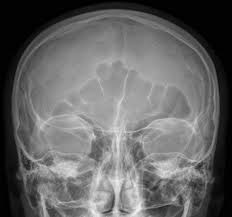 Image result for Sinus X Ray