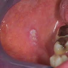 Image result for spinocellular carcinoma of the oral cavity