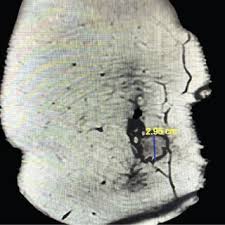 PDF) A Case of Painful Growing Abdominal Wall Mass during Pregnancy  Requiring Resection in the Second Trimester