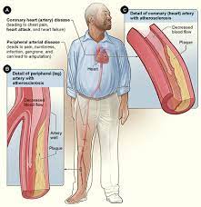 Difference Between Arteriosclerosis And Atherosclerosis Difference Between